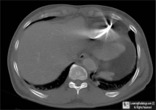 Perforated Pacemaker Lead